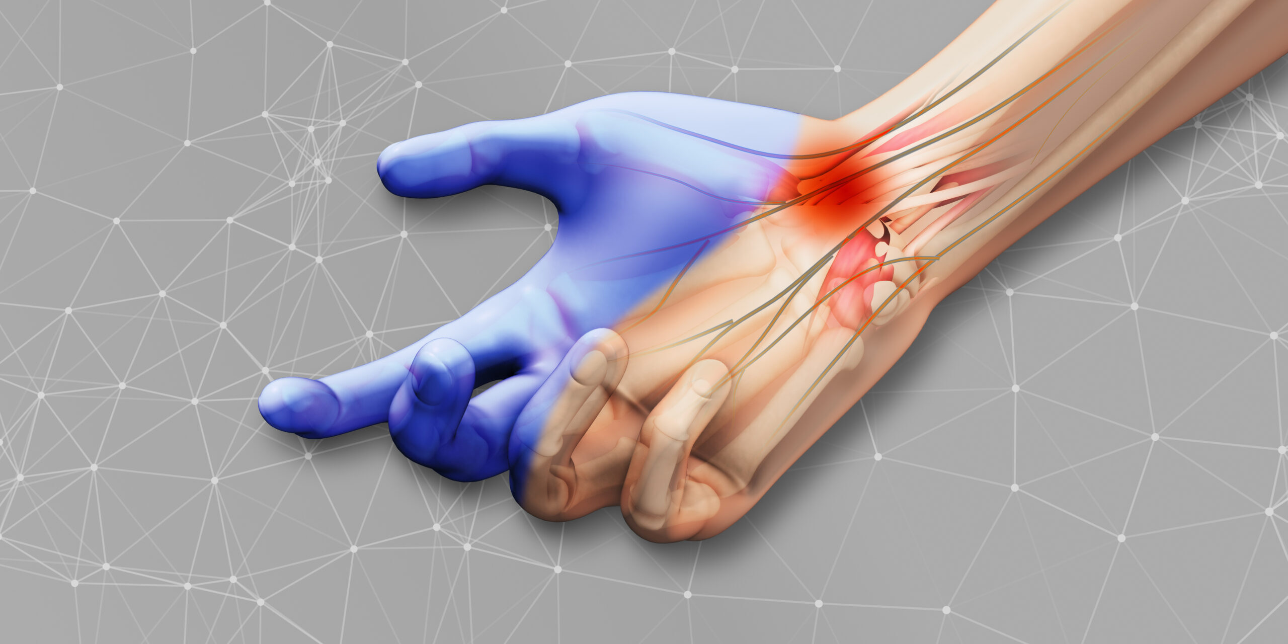 Carpal tunnel syndrome with plexus background